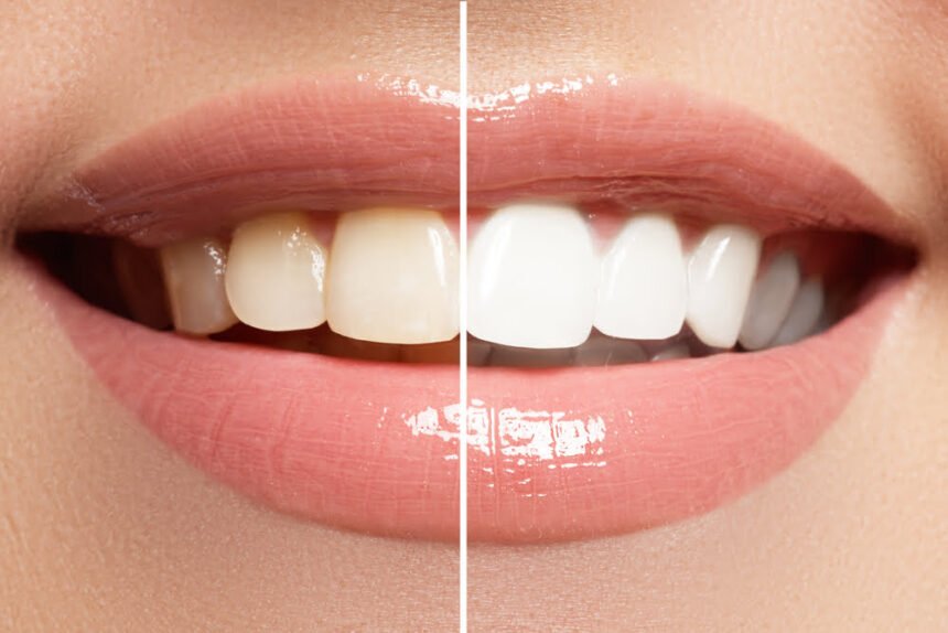 teeth whitening benefits