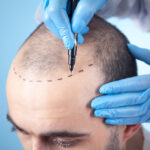 benefits of getting a hair transplant in turkey