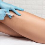 use sclerotherapy to treat varicose veins