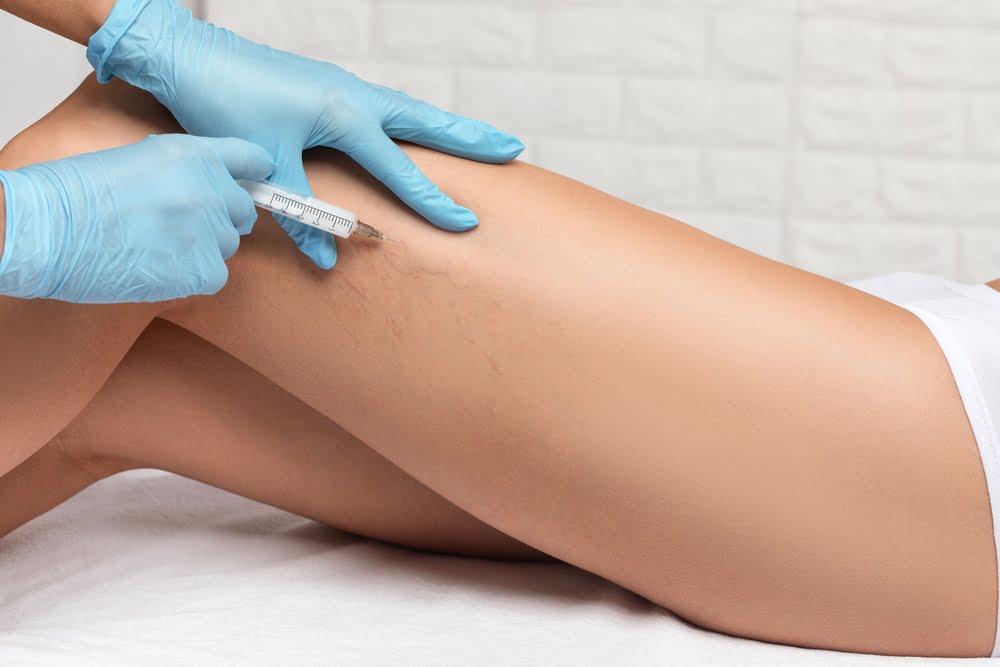 use sclerotherapy to treat varicose veins