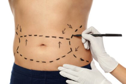 prepare for a cosmetic surgery