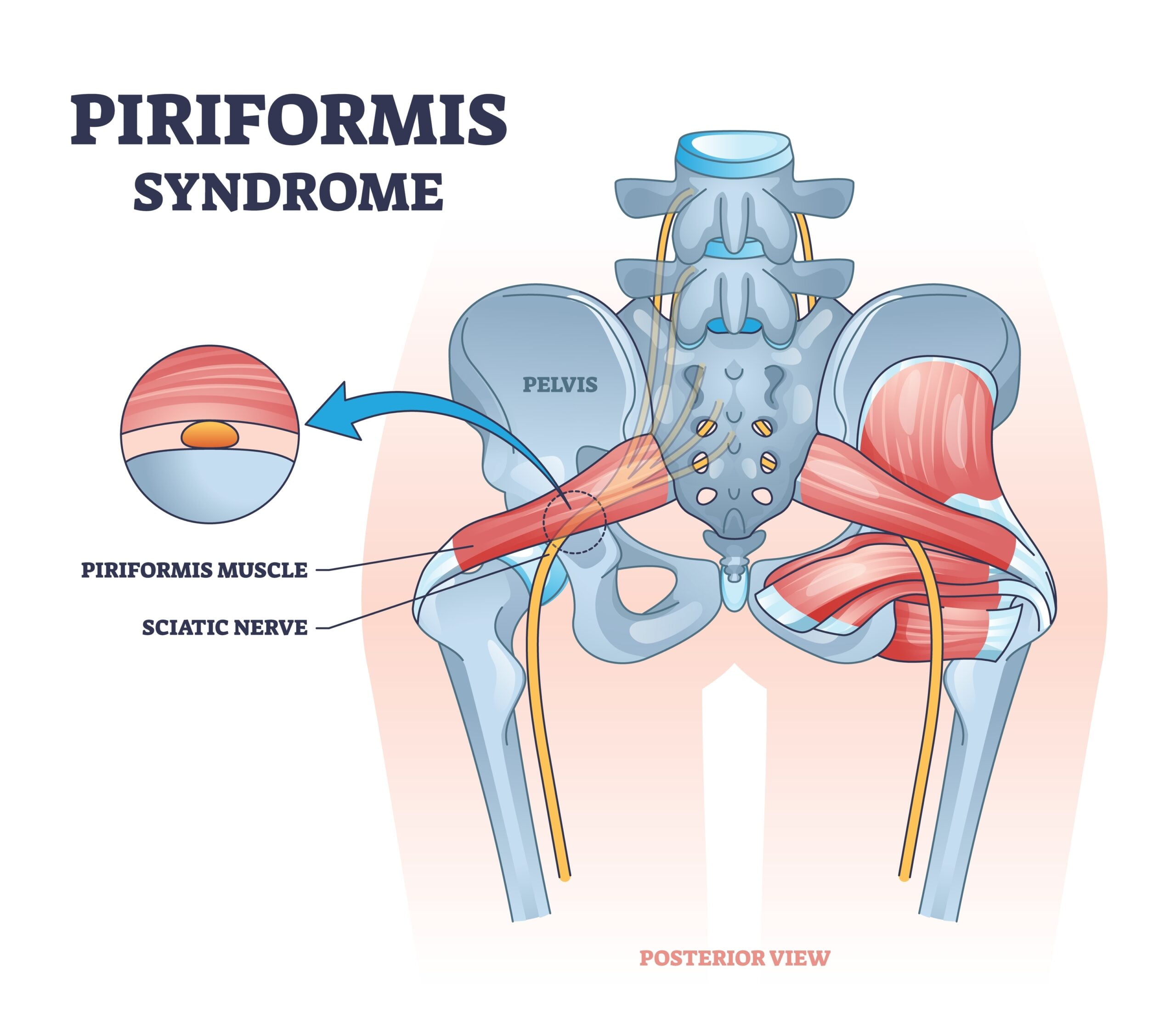 Piriformis Syndrome and Sciatica Pain – Caring Medical Florida