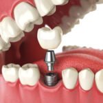 all-in-four dental implant benefits