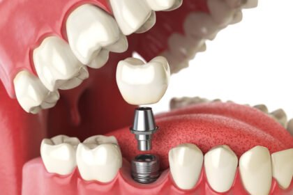 all-in-four dental implant benefits