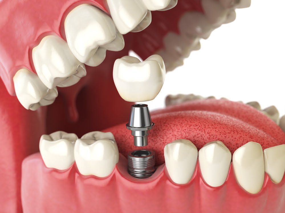 all-in-four dental implant benefits