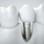 Dental Implant Failure: Possible Causes and Prevention