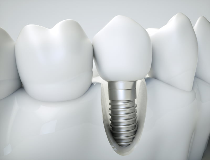 Dental Implant Failure: Possible Causes and Prevention