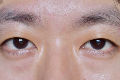 do monolids become eyelids