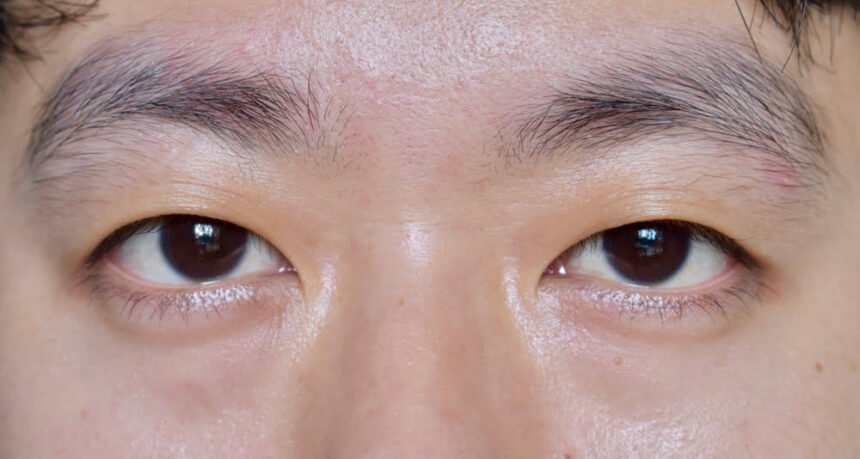 Monolid to sales double eyelid