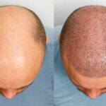hair transplants for cancer patients