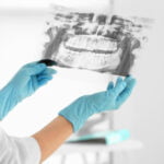 dental x-rays explained
