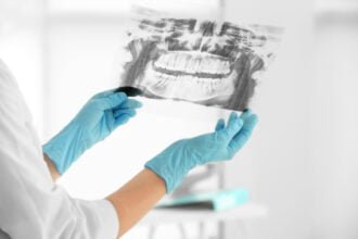 dental x-rays explained