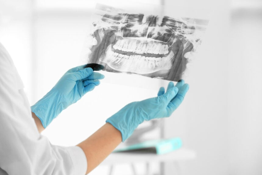 dental x-rays explained