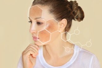 combat Melasma