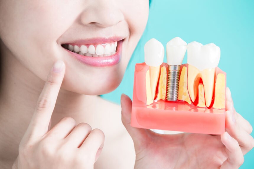 dental implant