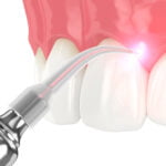 Treating Gum Disease