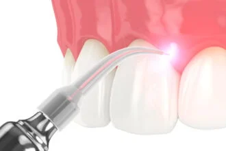 Treating Gum Disease