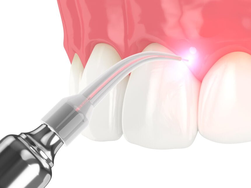 Treating Gum Disease