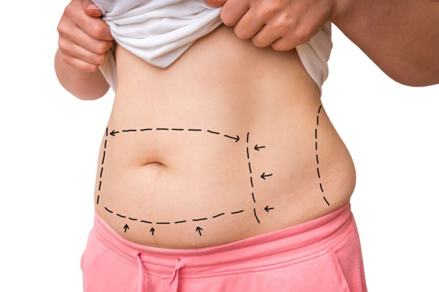 tummy tuck steps