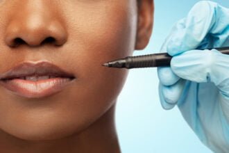 african american dermal filler