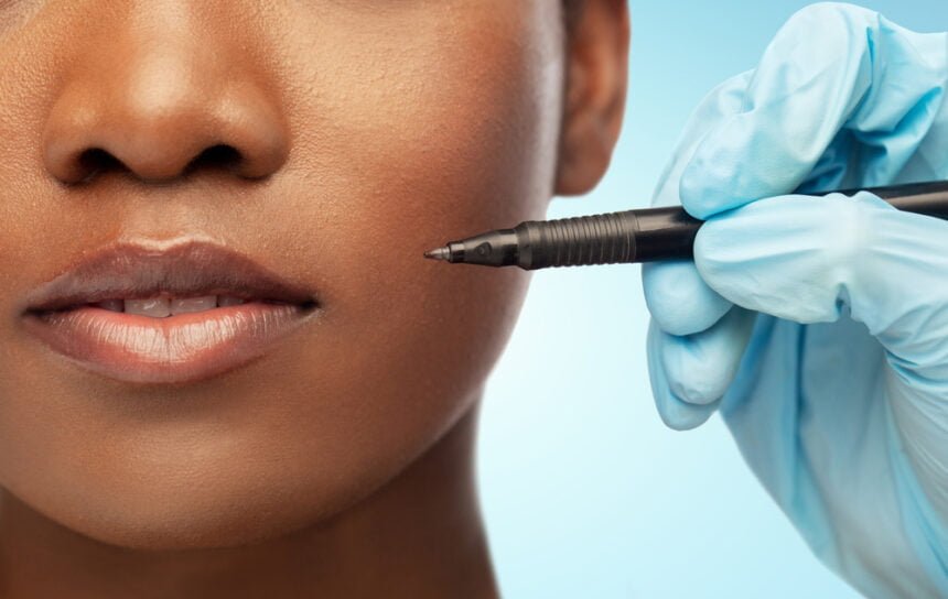 african american dermal filler