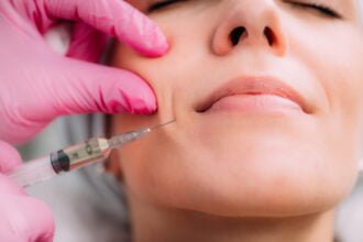 Dermal Filler Injection for Nasolabial Folds