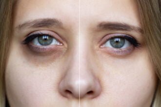 dark circle treatments
