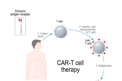 CAR-T-cell Therapy