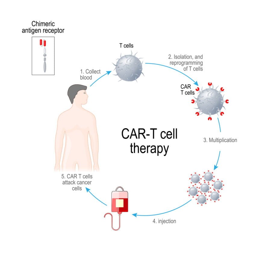 CAR-T-cell Therapy