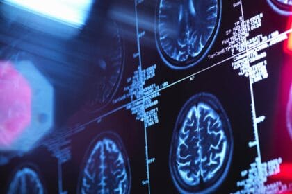 Traumatic Brain Injuries