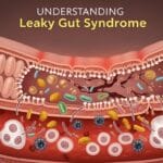 Understanding Leaky Gut Syndrome